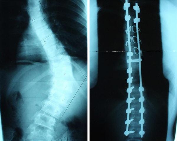6. Skolyoz ameliyatı öncesi ve sonrasında sırt röntgeni.