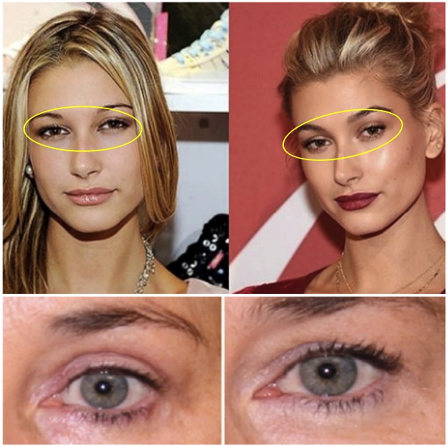 Surekli Bahsedilse De Neyin Ne Oldugunu Bir Turlu Anlamayanlar Icin Yuze Yapilan Tum Estetik Operasyonlari Tek Tek Anlatiyoruz Surekli Bahsedilse De Neyin Ne Oldugunu Bir Turlu Anlamayanlar Icin Yuze Yapilan Tum Estetik Operasyonlari Tek Tek Anlatiyoruz