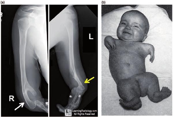 Thalidomide'ye maruz kalan bebeklerin genelinde 'fokomeli' görülüyor. Yani elleri ve ayakları gelişemiyor, kasıktan ya da omuzdan deforme halde uzuvlar çıkıyor.