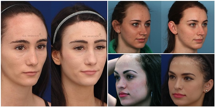 Geniş Alın Artık Kader Değil: Yüzü Tamamen Değiştiren ve Giderek Popülerleşen Alın Daraltma Operasyonu