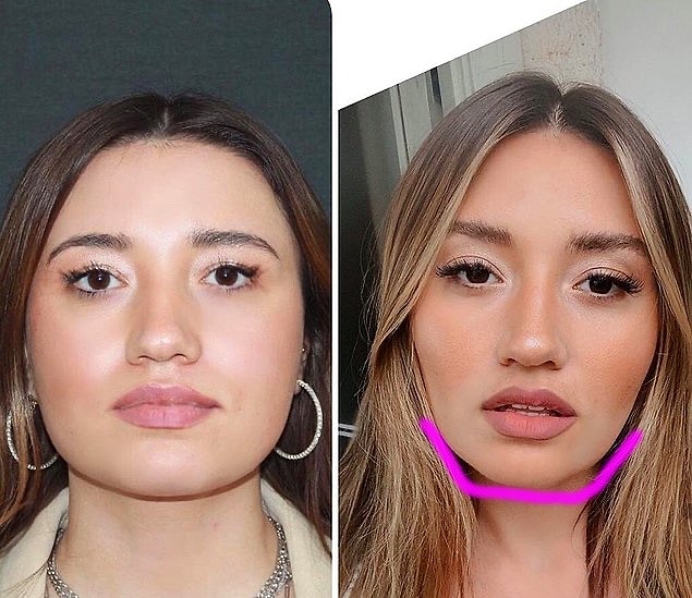 Masseter kasının yer aldığı yüzün alt kısmının inceltildiği Masseter Botoks,