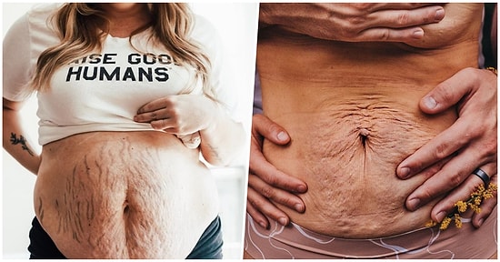 Hamilelikte Vücutlarında Oluşan Çatlaklar ile Poz Veren Kadınları Görünce Anne Olmadan Önce Bir Kez Daha Düşüneceksiniz!