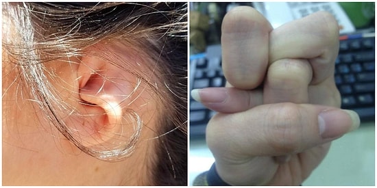 Bu İnanılmaz Vücut Özelliklerine Sahip İnsanların Fotoğraflarına Bakarken İçiniz Bir Tuhaf Olabilir!