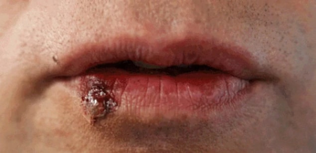 2. Uçuk, genital bölgeye yayılmaz.