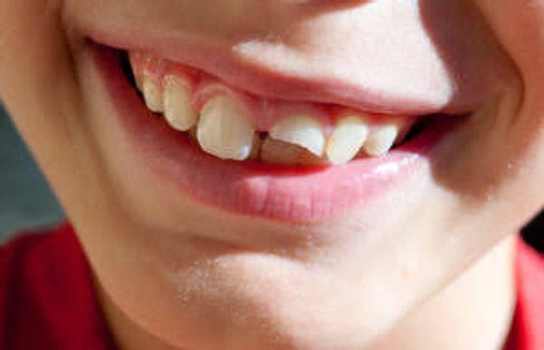 9. Kopan dişinizi 5 dakika içinde çıktığı kısma yerleştirip doktorun yolunu tutarsanız, kimi zaman bu diş kurtarılabilir.