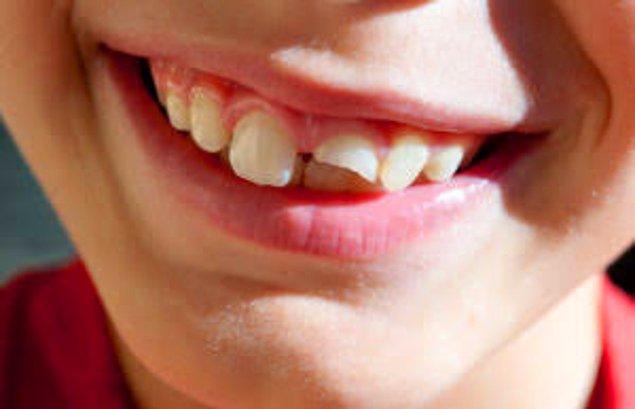 9. Kopan dişinizi 5 dakika içinde çıktığı kısma yerleştirip doktorun yolunu tutarsanız, kimi zaman bu diş kurtarılabilir.