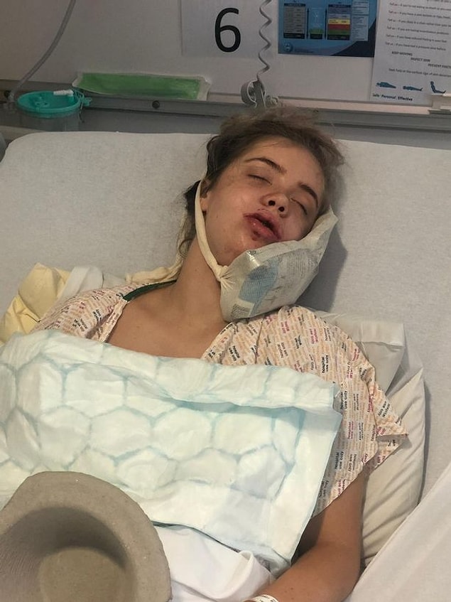 4 saat süren ağır ameliyatta hem üst hem alt çenesi kırıldı ve tekrar hizalandıktan sonra vidalarla sabitlendi.