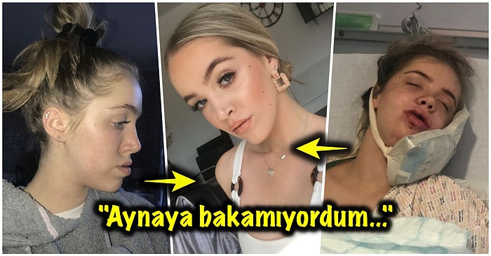 Alt Çenesi Çıkık Olduğu İçin Yıllarca Zorbalığa Maruz Kaldıktan Sonra Geçirdiği Ameliyatla Bambaşka Birine Dönüşen Kadın