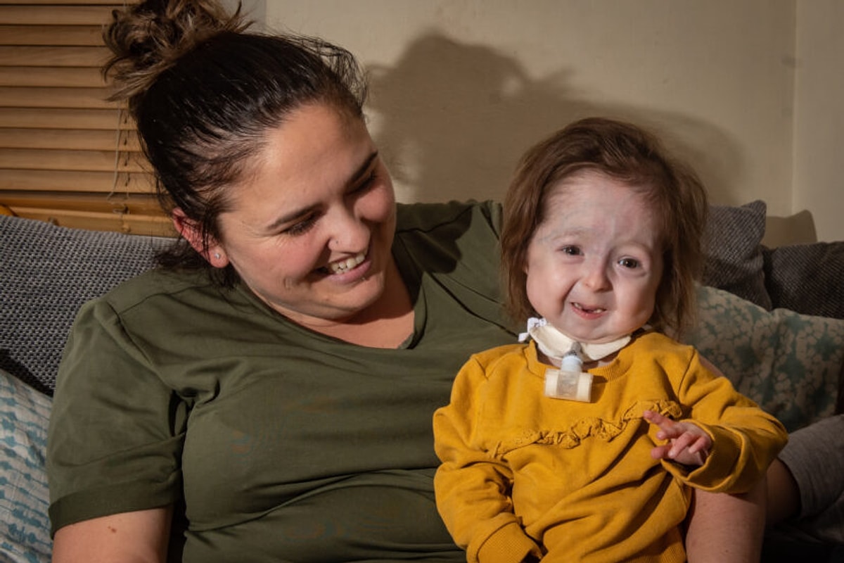 Dünya Üzerinde Sadece 2 Yaşındaki Isla KilpatrickScreaton'ın Sahip