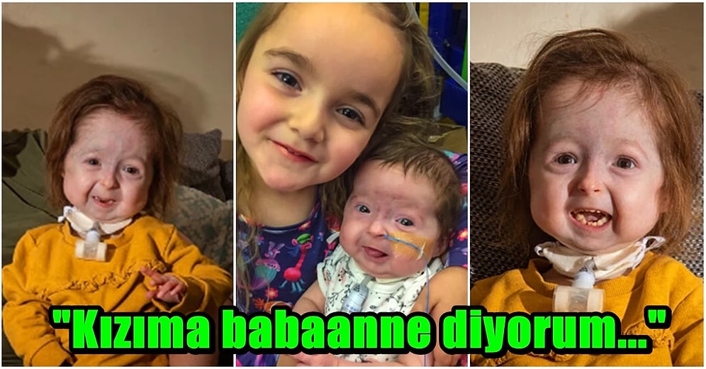 Dünya Üzerinde Sadece 2 Yaşındaki Isla Kilpatrick-Screaton'ın Sahip Olduğu 'Benjamin Button Hastalığı'
