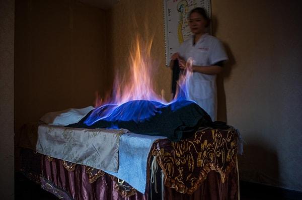 85. Çin'de tedavi amaçlı alkole batırılan kumaş parçası hastanın üstüne seriliyor ve ateşe veriliyor. Bu yöntemin işe yaradığına dair bir kanıt yok ama devam etmekte. Bir Fritz Hoffman fotoğrafı.