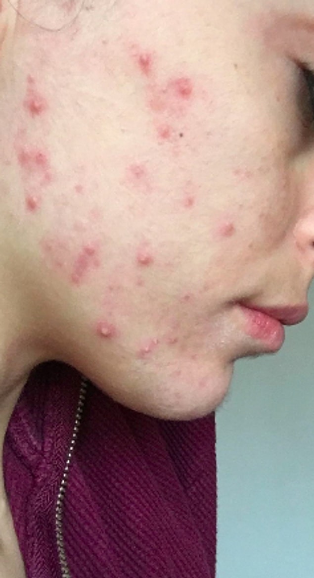 Fotoğraflarda belki çok net değil ama şu anki halim bu. Ocak ayının ilk haftası tekrar gidip karaciğer testi yaptıracağım ve sonuca göre ilaca devam edeceğim. İlk ayım bu şekilde geçti, 2. ay daha ağır geçecek gibi. Şimdilik ocak sonunda görüşmek üzere... 😎