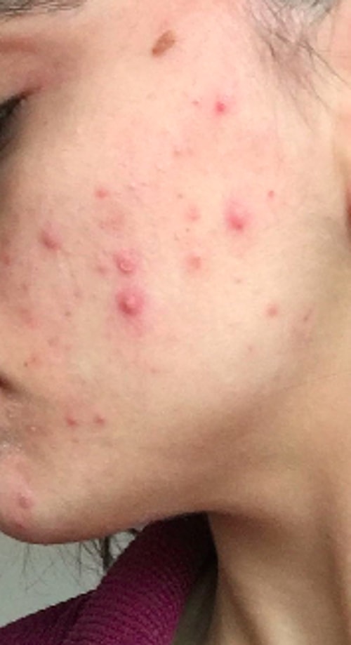Fotoğraflarda belki çok net değil ama şu anki halim bu. Ocak ayının ilk haftası tekrar gidip karaciğer testi yaptıracağım ve sonuca göre ilaca devam edeceğim. İlk ayım bu şekilde geçti, 2. ay daha ağır geçecek gibi. Şimdilik ocak sonunda görüşmek üzere... 😎