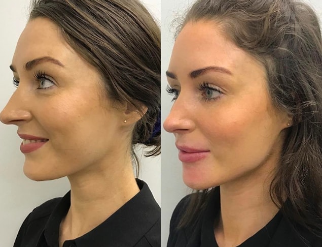 Buraya kadar sorunumuz yoksa, Jawline'ın nasıl yaptırıldığından bahsedelim...