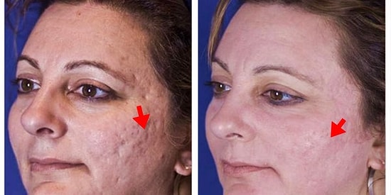 Cildinizde Oluşan Delik ve Çukurlardan Kurtulabilmek İçin Uygulayabileceğiniz Yöntemler