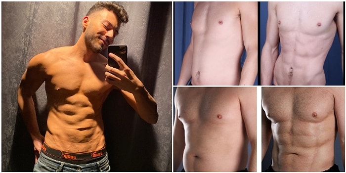 Enes Batur'un da Yaptırdığı İddia Edilen Sporsuz Vücut Geliştirme Operasyonu Vaser Liposuction