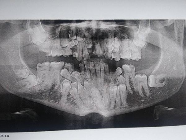 18. "Cleidocranial Dysotosis adında nadir görülen bir hastalığım var. İlk defa bugün diş filmi çektirdim ve ağzımın içerisinde birçok fazla diş olduğunu öğrendim."