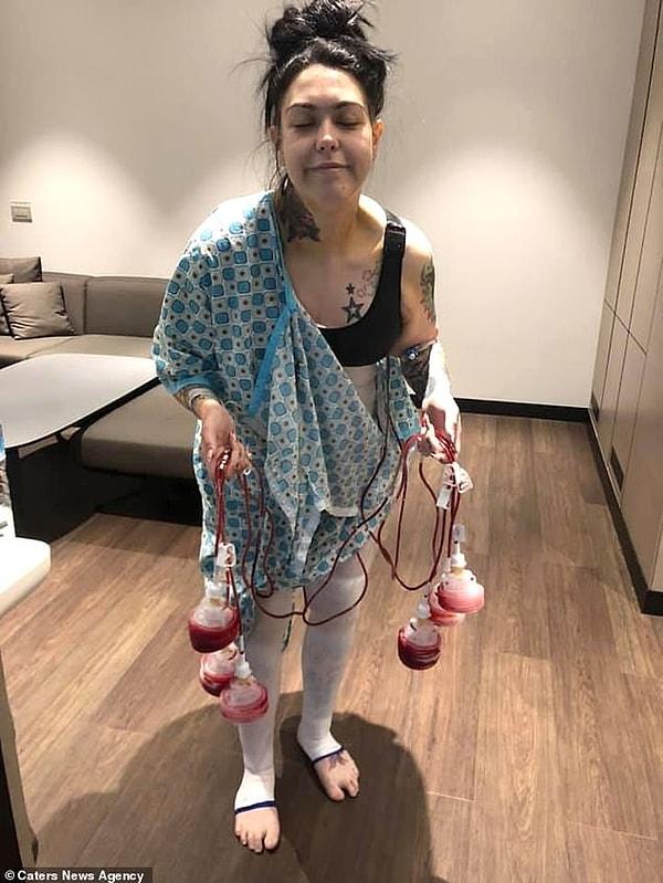 Yağ aldırma ameliyatından sonra, Zara Rodriguez’in drenlerle bir fotoğrafı…