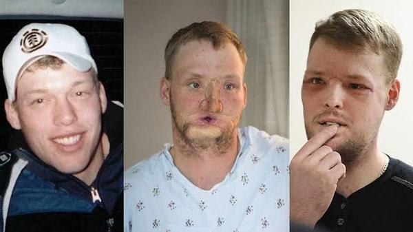 3. Andy Sandness'ın silah yaralanması sonucu yüzünde kalıcı hasar meydana geldi.