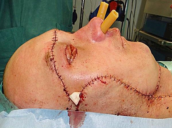 27 saatlik bir yüz nakil ameliyatı geçiren adamın aynı zamanda hayati tehlikesi vardı.