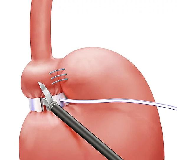 3. Mide kelepçesi ameliyatı, yemek borusunun mideye giriş yerinin hemen altından mideyi bir kelepçe gibi sıkıştırarak yapılan bir yöntem.