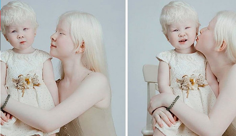 12 Yıl Arayla Doğan Albino Kız Kardeşlerden Farklı Olmanın