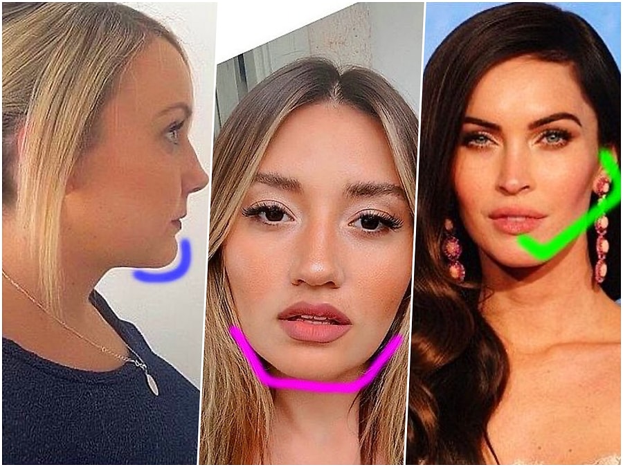 Son Dönemin En Popüler Estetik Operasyonu Jawline ile Resmen Bambaşka