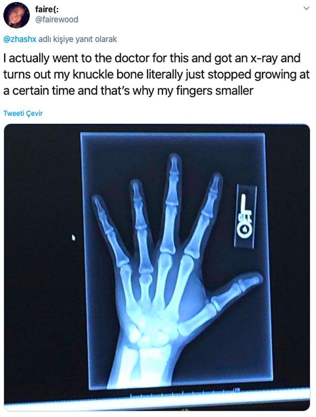 11. "Ben bunun için doktora bile gittim, film çekildi ve yüzük parmağımdaki eklemin bir ara büyümeyi durdurduğunu öğrendim, bu yüzden parmaklarım küçük"