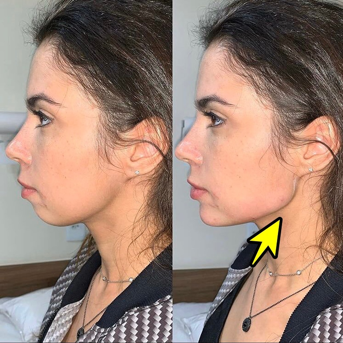 Son Dönemin En Popüler Estetik Operasyonu Jawline ile Resmen Bambaşka