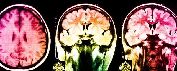 Reduplikatif paramnezi, yanılgısal misidantifikasyon sendromlarından biridir ve nadir görünmesine rağmen sıklıkla beyin hasarı ile ilişkilendirilmektedir.