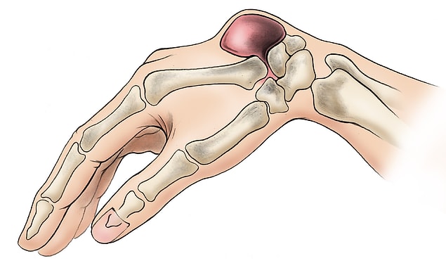 20. Ganglion kisti