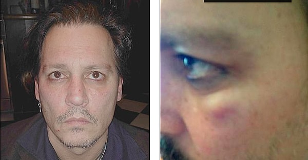 В рамках дела о клевете против Херд на 50 миллионов долларов, Депп включил изображения своего собственного избитого лица (слева и справа) после предполагаемых нападений Херд.