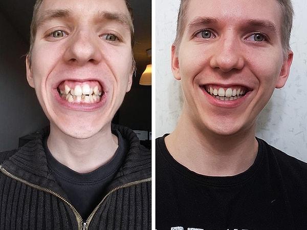 6. "Neredeyse 2 yıl sonra, bugün diş tellerim çıktı."