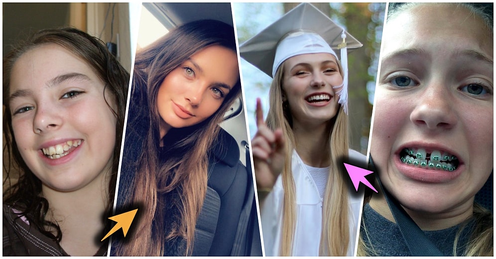 Diş Teli Tedavisinin Ardından Bambaşka Birine Dönüşerek Eski Sevgililerini Üzüntüden Yataklara Düşüren 23 Kişi