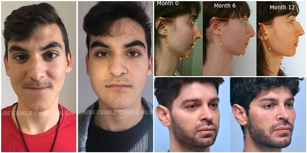 Ameliyatsız, Operasyonsuz Çene Hattını Belirginleştiren ve Jawline Dolgusu Etkisi Yaratan Egzersiz: Mewing