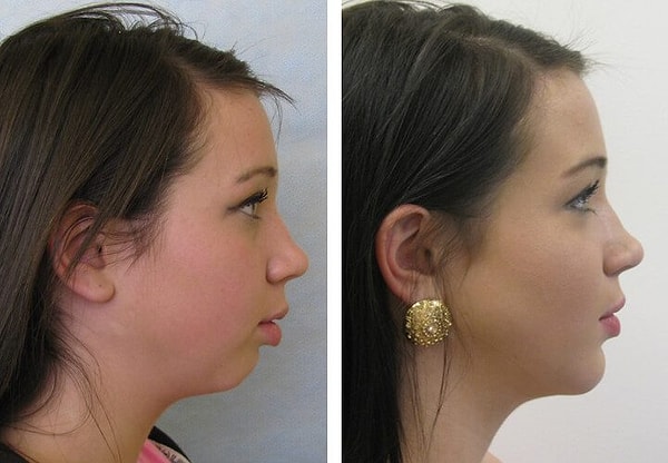 В последние годы эстетическая медицина акцентирует внимание на важности красивого подбородка и линии скул. Появились такие процедуры как контурная пластика подбородка и контурная пластика овала лица.