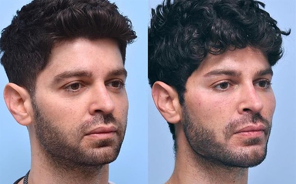 Однако у многих людей также есть врожденные проблемы с челюстью. И это одна из главных причин популярности этих процедур.