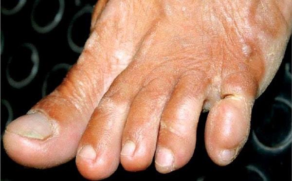 10. Ainhum isimli hastalıkta, hastaların ayak parmağı durup dururken birkaç gün içinde düşer ve doktorlar bunun neden olduğunu bilemezler.
