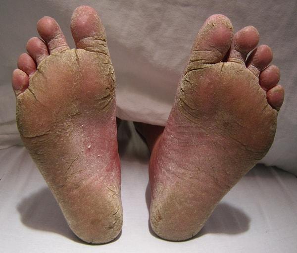 Deri üstündeki sporların, sıcak ve nemle üreyerek enfeksiyon kapması sonucu da oluşabilir. Tedavinin süresiyse, ayak mantarının ulaştığı boyutun ciddiyetine göre kişiden kişiye değişiklik gösterebilir.