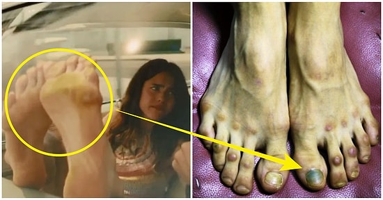 Hayatınızı Birdenbire Kabusa Çevirebilen Sonrasında Semptomlarıyla İnsanı Delirtebilecek Bir Rahatsızlık: Ayak Mantarı