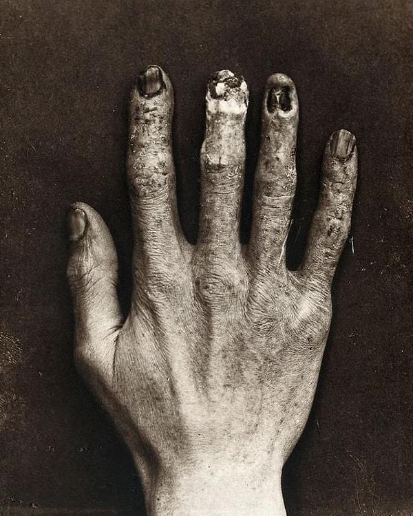 4. Radyasyondan zarar gören bir el, 1900.
