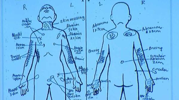 Sağlık ekipleri, Gabriel'in kaburgasının kırıklar, kafatasında çatlak ve vücudunda yanık izleri tespit ediyorlar.
