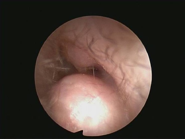 5. У серферов часто наблюдается рост ушных опухолей, которые начинают закрывать ушной канал.