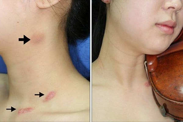 6. У скрипачей на шее остаются такие штуки, похожие на засосы.