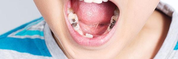 Çocuklarda florürlü diş macunu tek başına çürükleri engellemeye yeterli mi?