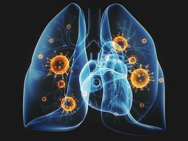 Zatürre akciğerlerin hava keseciklerinin iltihaplanmasına neden oluyor.