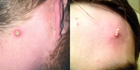 Sivilce Patlatırken Keyifle Kahır Arası Bir Şey Hisseden Herkesin Bayılacağı 17 Fotoğraf