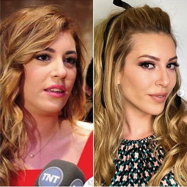 1. Sinem Kobal'ın değişiminde kilo verme ve çene dolgusunun etkisi var gibi görünüyor.