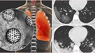 Koronavirüsten İyileşen Bazı Hastaların Kalıcı Akciğer Hasarlarına Maruz Kalabilecekleri Söyleniyor!