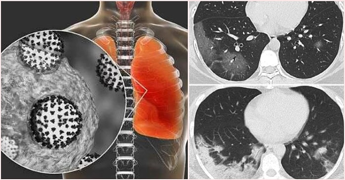 Koronavirüsten İyileşen Bazı Hastaların Kalıcı Akciğer Hasarlarına Maruz Kalabilecekleri Söyleniyor!